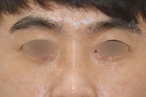 눈 after이미지