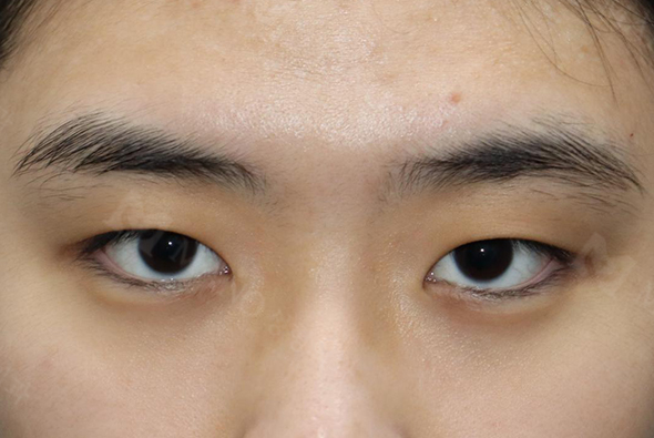눈 before이미지