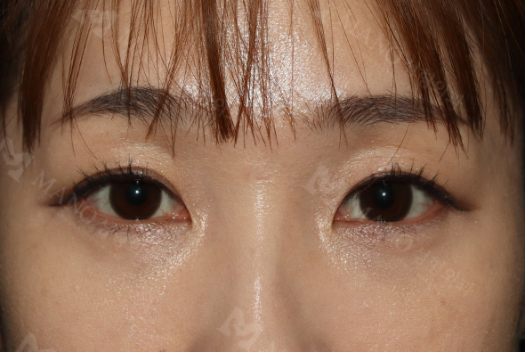 눈 after이미지