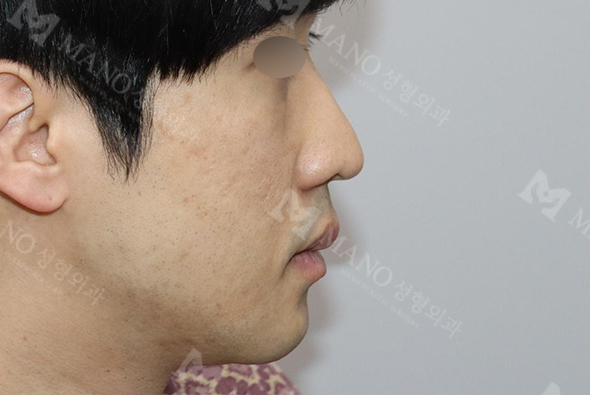눈 before이미지