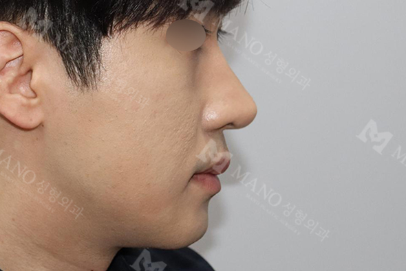 눈 after이미지