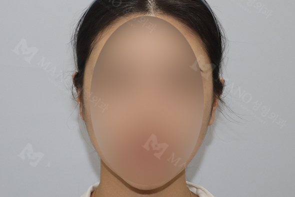 눈 before이미지