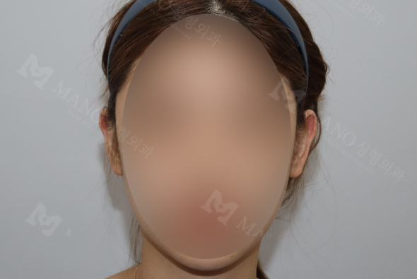 눈 before이미지