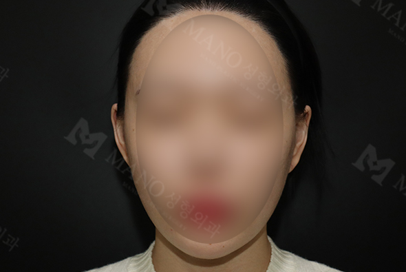 눈 before이미지